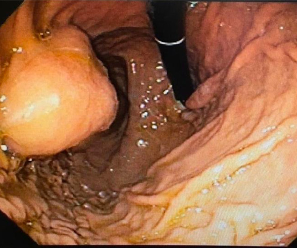 endoscopia_